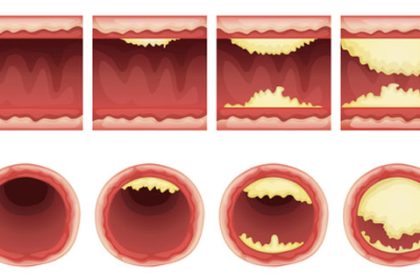 hoe ontstaat cholesterol