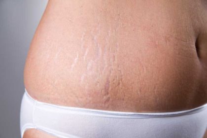Tips om striae te verminderen