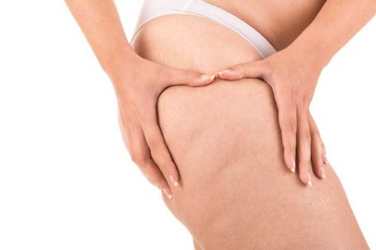 Hoe kun je cellulitis verminderen?