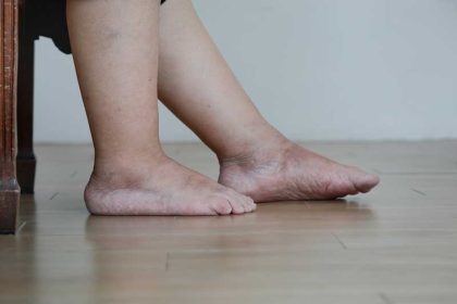 Welke voeding helpt tegen vocht vasthouden bij warm weer?