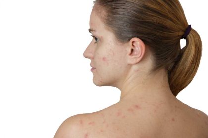 Veroorzaakt koffie en thee drinken meer acne en puistjes?