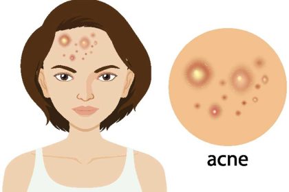 Problemen met acne boven de 40 jaar