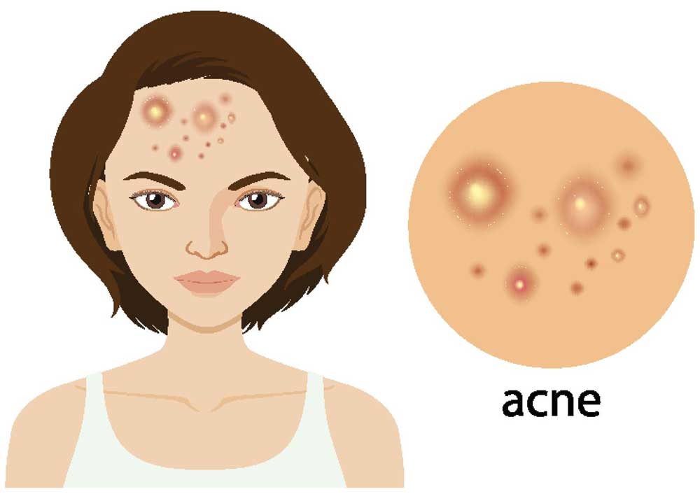 Problemen met acne boven de 40 jaar
