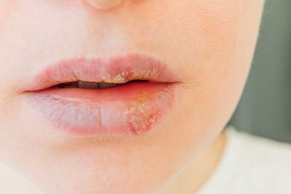 Helpt l-lysine tegen een koortslip?