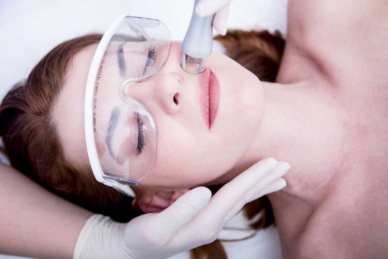 CO2 laserbehandeling tegen huidveroudering in het gezicht